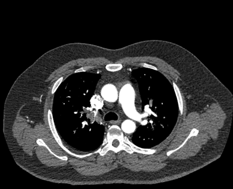 Acute pulmonary embolism with pulmonary infarcts (Radiopaedia 77688-89908 Axial C+ CTPA 21).jpg