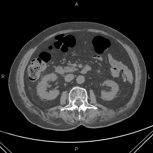 File:Acute renal artery occlusion (Radiopaedia 86586-102682 Axial non-contrast 34).jpg