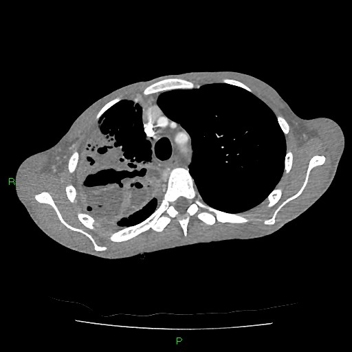 File:Acute right lung abscess (Radiopaedia 34806-36258 Axial C+ arterial phase 47).jpg