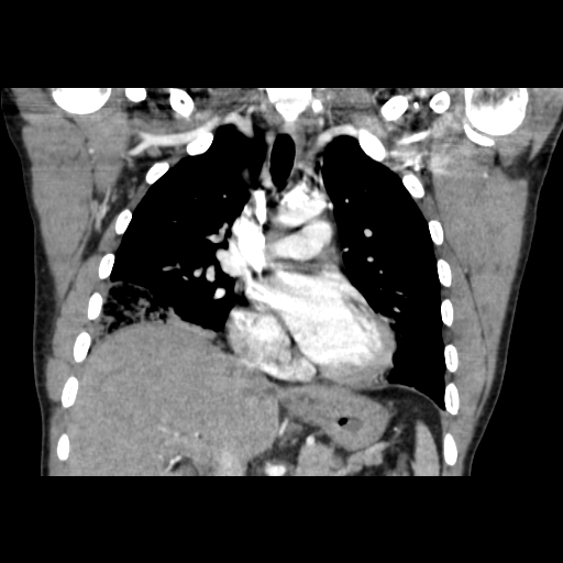Acute segmental pulmonary emboli and pulmonary infarction (Radiopaedia 62264-70444 Coronal C+ CTPA 23).jpg