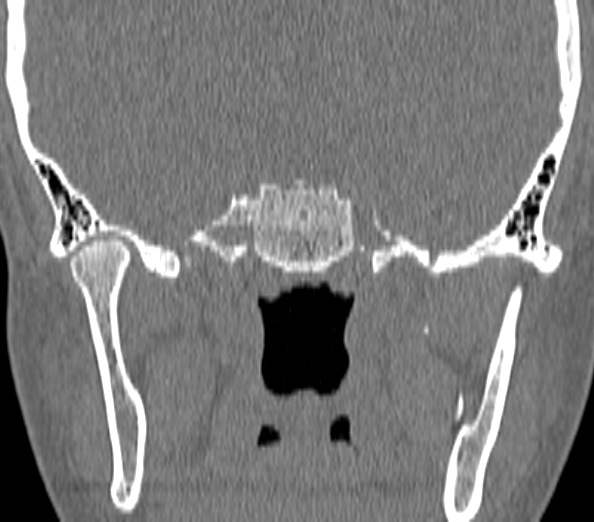 Acute sinusitis (Radiopaedia 40564-43158 Coronal bone window 47).jpg