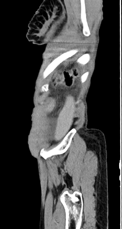 Acute small bowel (ileal) volvulus (Radiopaedia 71740-82139 Sagittal C+ portal venous phase 28).jpg