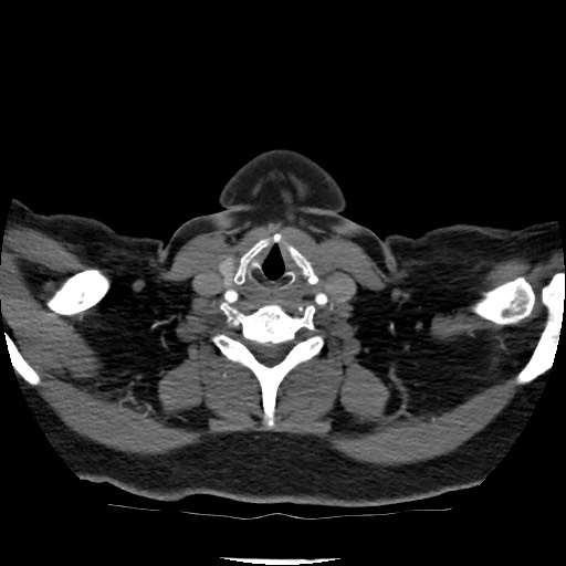 Acute subarachnoid hemorrhage and accessory anterior cerebral artery (Radiopaedia 69231-79009 Axial C+ arterial phase 39).jpg