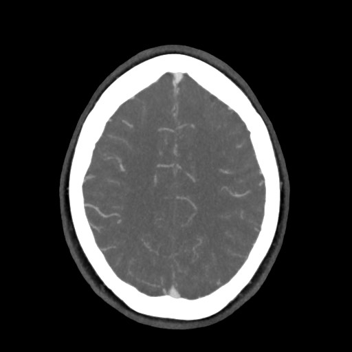 Acute subarachnoid hemorrhage and accessory anterior cerebral artery (Radiopaedia 69231-79009 D 52).jpg