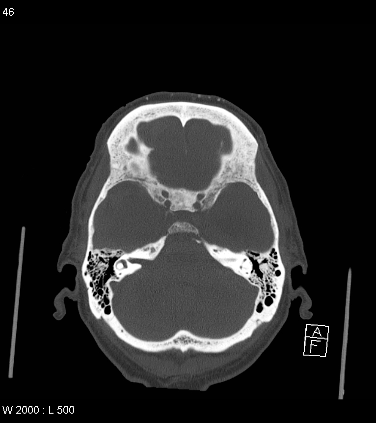 Acute subdural hematoma with myelofibrosis (Radiopaedia 52582-58494 Axial bone window 23).jpg