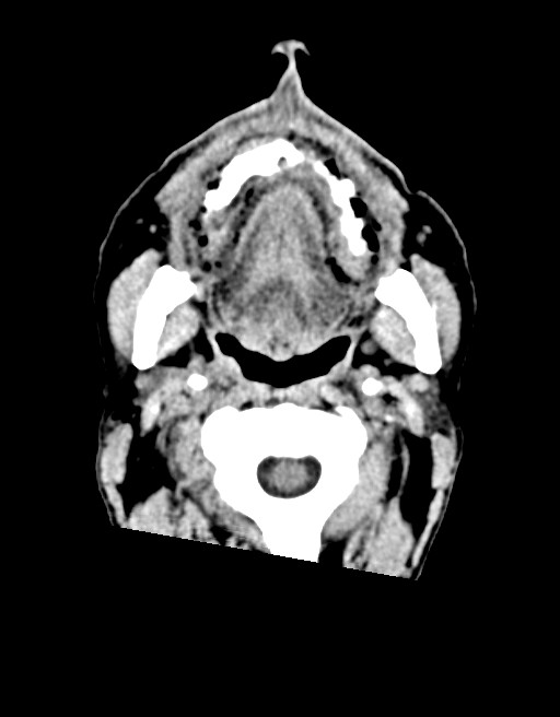 Acute superior cerebellar artery territory infarct (Radiopaedia 84104-99359 Axial non-contrast 74).jpg
