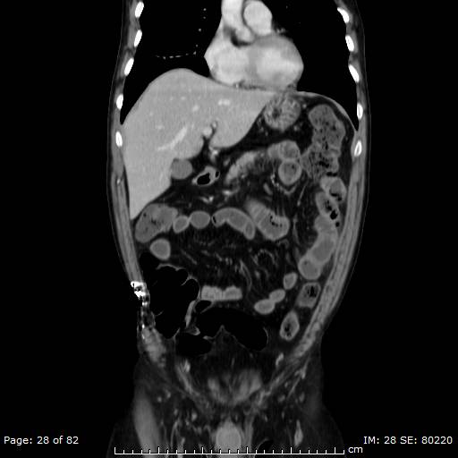 Acute superior mesenteric artery occlusion (Radiopaedia 43636-47060 Coronal C+ portal venous phase 13).jpg