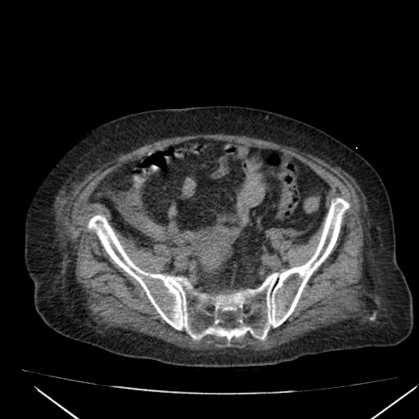 Acute tubular necrosis (Radiopaedia 28077-28334 Axial non-contrast 53).jpg