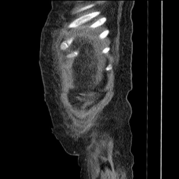 Acute tubular necrosis (Radiopaedia 28077-28334 Sagittal non-contrast 11).jpg