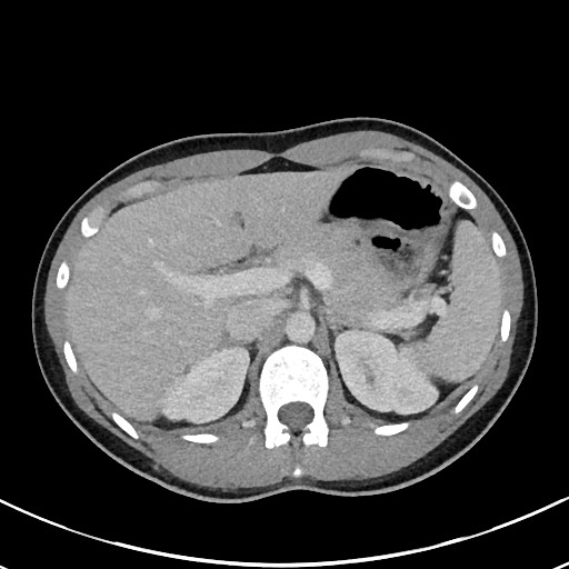 File:Acute uncomplicated appendicitis (Radiopaedia 61374-69304 Axial C+ portal venous phase 29).jpg
