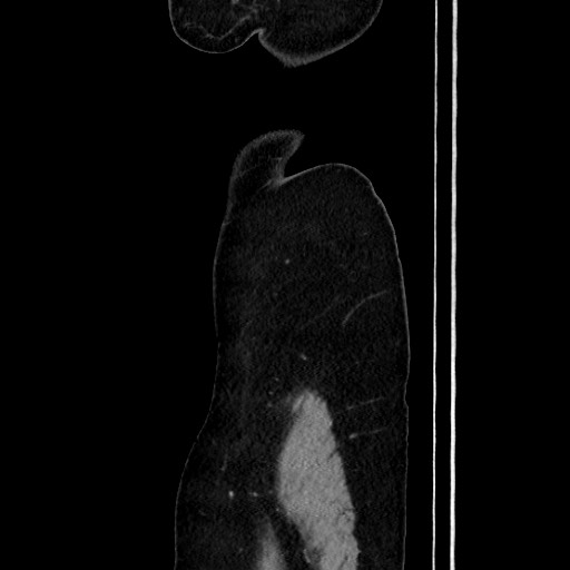 Acute uncomplicated appendicitis (Radiopaedia 73704-84499 Sagittal C+ portal venous phase 34).jpg
