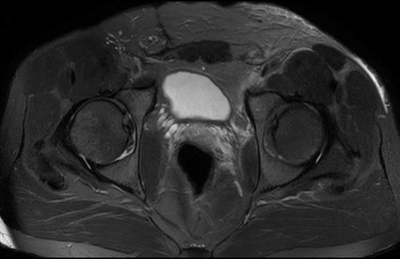 File:Adductor longus tear with retraction (Radiopaedia 56424-63103 Axial T2 fat sat 13).jpg