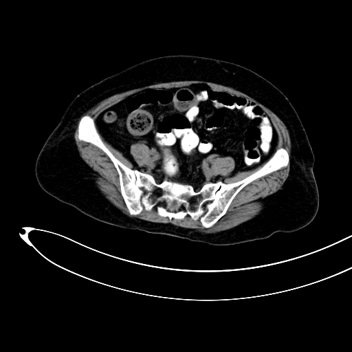 Adenocarcinoma colon with intussusception (Radiopaedia 86006-101922 Axial non-contrast 43).jpg