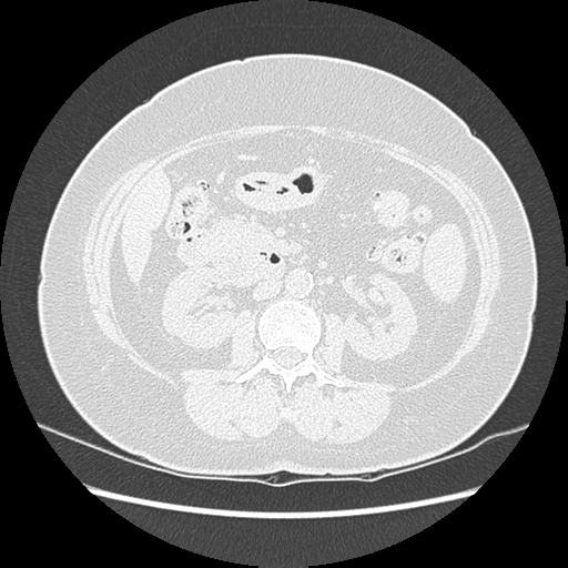 Adenocarcinoma in situ of lung (Radiopaedia 38685-40829 B 263).png