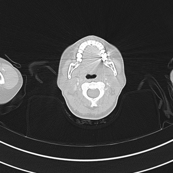 Adenocystic carcinoma of the trachea (Radiopaedia 47677-52525 Axial lung window 10).jpg