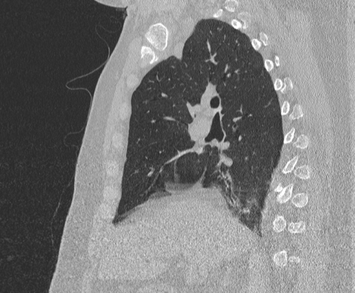 File:Adenoid cystic carcinoma of the trachea (Radiopaedia 49042-54137 Sagittal lung window 192).jpg