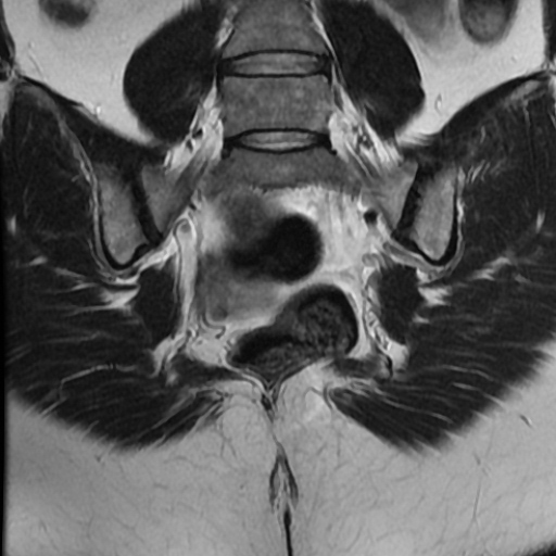 File:Adenoma malignum of cervix (Radiopaedia 66441-75705 Coronal T2 19).jpg