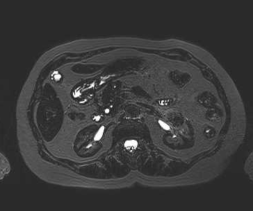 File:Adenomyomatosis of the gallbladder (Radiopaedia 50246-55587 Axial 30).png