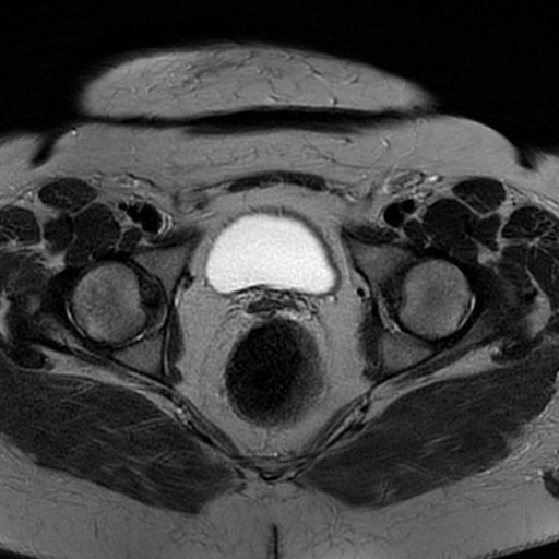 File:Adenomyosis within a didelphys uterus (Radiopaedia 70175-80215 Axial T2 27).jpg