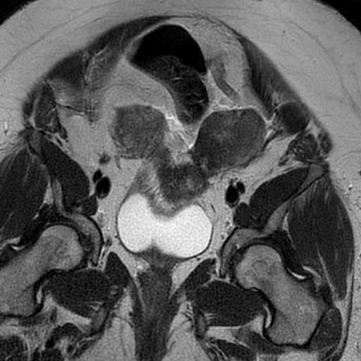 File:Adenomyosis within a didelphys uterus (Radiopaedia 70175-80215 Coronal T2 12).jpg