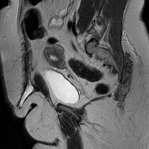 File:Adenomyosis within a didelphys uterus (Radiopaedia 70175-80215 Sagittal T2 13).jpg