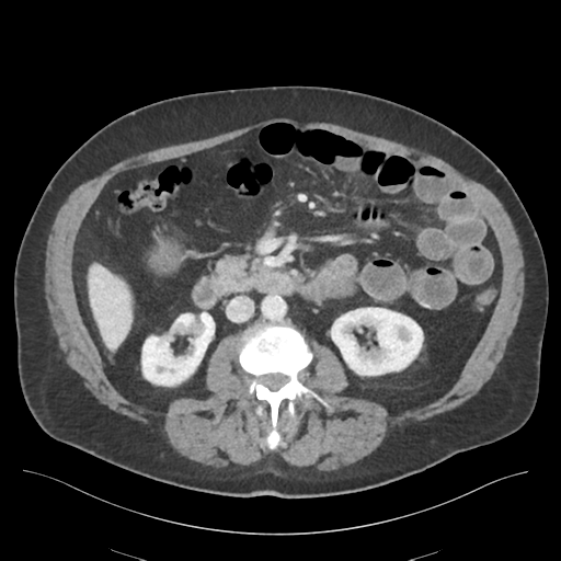 Adhesions within abdominal wall hernia (Radiopaedia 58283-65394 Axial C+ portal venous phase 39).png