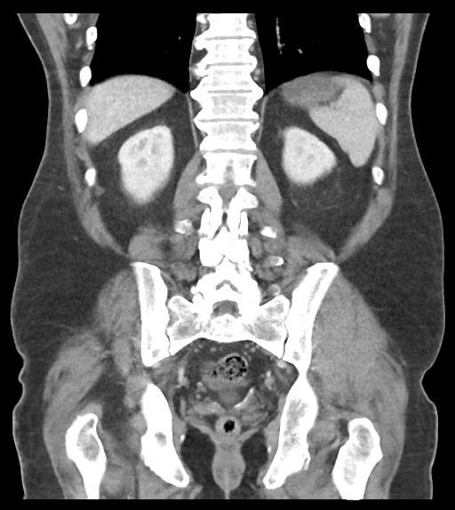 Adhesions within abdominal wall hernia (Radiopaedia 58283-65394 Coronal C+ portal venous phase 52).png