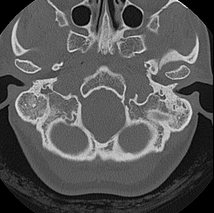 File:Adhesive chronic otitis media (Radiopaedia 14270-14148 Axial bone window 20).jpg