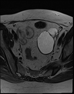 File:Adnexal multilocular cyst (O-RADS US 3- O-RADS MRI 3) (Radiopaedia 87426-103754 Axial T2 11).jpg