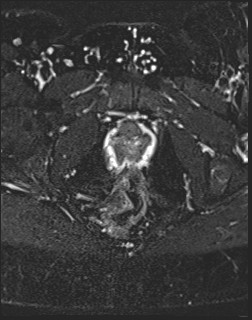 File:Adnexal multilocular cyst (O-RADS US 3- O-RADS MRI 3) (Radiopaedia 87426-103754 Axial T2 fat sat 22).jpg