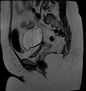 File:Adnexal multilocular cyst (O-RADS US 3- O-RADS MRI 3) (Radiopaedia 87426-103754 Sagittal T2 17).jpg