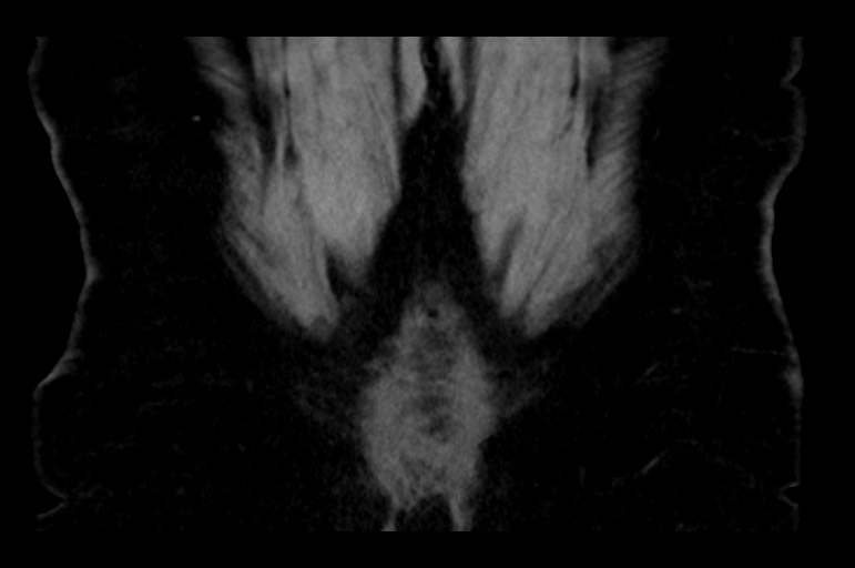 Adrenal cortical carcinoma (Radiopaedia 64017-72769 Coronal non-contrast 55).jpg