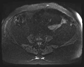 Adrenal cortical carcinoma (Radiopaedia 64017-72770 Axial DWI 86).jpg