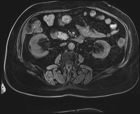 Adrenal cortical carcinoma (Radiopaedia 64017-72770 Axial T1 C+ fat sat 29).jpg