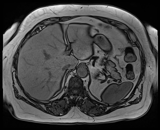 File:Adrenal cortical carcinoma (Radiopaedia 64017-72770 Axial T1 out-of-phase 16).jpg