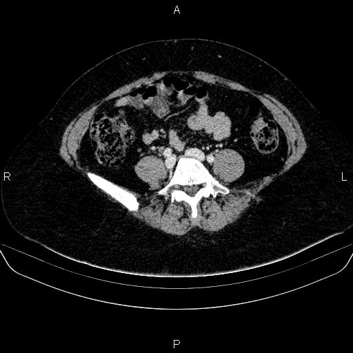 Adrenal cortical carcinoma (Radiopaedia 84882-100379 Axial C+ portal venous phase 62).jpg