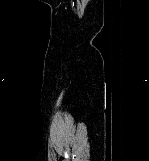 Adrenal cortical carcinoma (Radiopaedia 84882-100379 Sagittal C+ portal venous phase 89).jpg