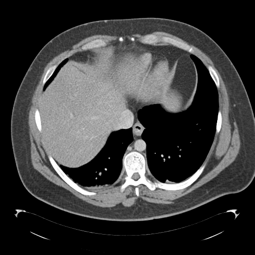 File:Adrenal cyst (Radiopaedia 45625-49776 Axial C+ portal venous phase 13).png