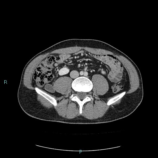 Adrenal cystic lymphangioma (Radiopaedia 83161-97534 Axial C+ portal venous phase 59).jpg