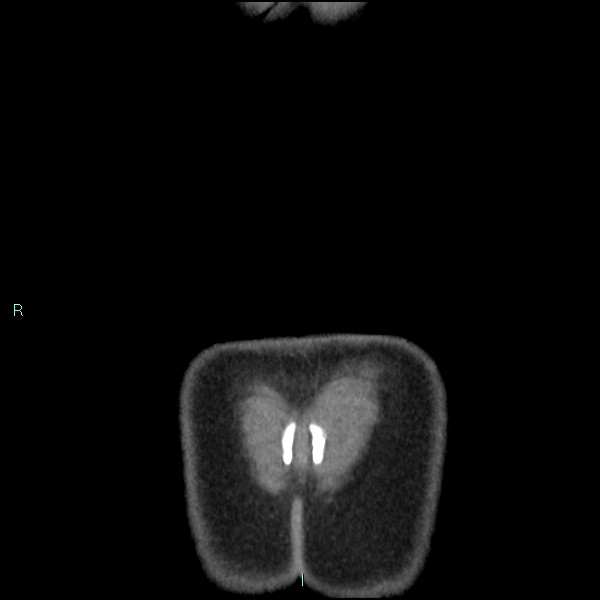 Adrenal cystic lymphangioma (Radiopaedia 83161-97534 Coronal C+ portal venous phase 79).jpg