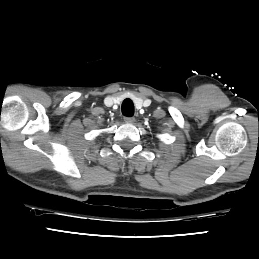 Adrenal gland trauma (Radiopaedia 81351-95078 Axial Dual bolus trauma C+ 11).jpg
