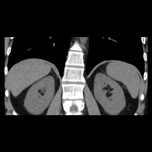 Adrenal gland trauma (Radiopaedia 81351-95079 Coronal non-contrast 63).jpg
