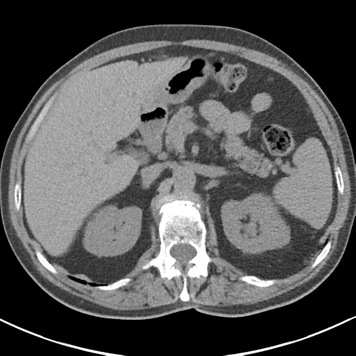 File:Adrenal hematoma (Radiopaedia 44334-47967 Axial non-contrast 31).png