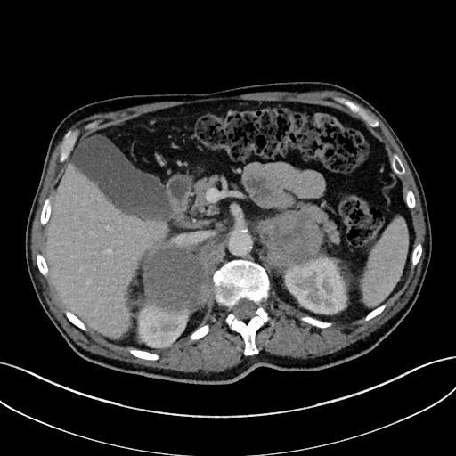 Adrenal lymphoma (Radiopaedia 73730-84529 Axial C+ portal venous phase 35).jpg