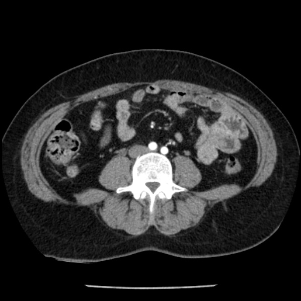 Adrenal myelolipoma (Radiopaedia 43401-46759 Axial C+ arterial phase 62).jpg