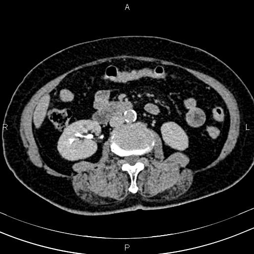 Adrenal myelolipoma (Radiopaedia 82742-96986 Axial renal excretory phase 75).jpg