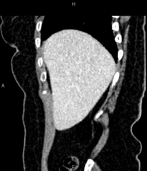 File:Adrenal myelolipoma (Radiopaedia 82742-96986 Sagittal renal cortical phase 21).jpg