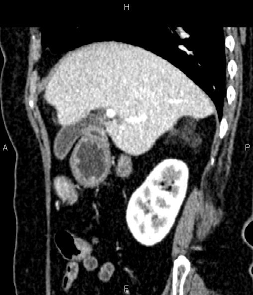 File:Adrenal myelolipoma (Radiopaedia 82742-96986 Sagittal renal cortical phase 37).jpg