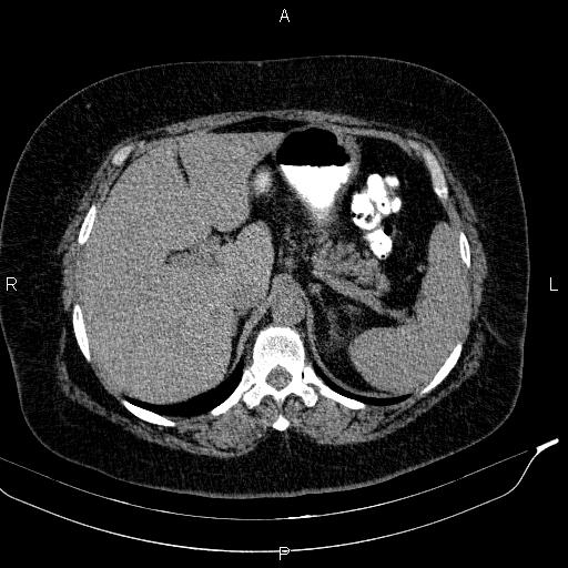 File:Adrenal myelolipoma (Radiopaedia 84319-99617 Axial With oral contrast 55).jpg