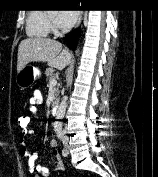 Adrenal myelolipoma (Radiopaedia 84319-99617 Sagittal renal cortical phase 47).jpg